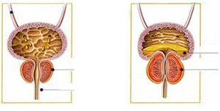 Gizonen prostatitis motak eta moduak