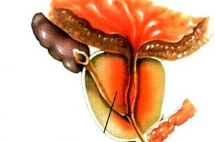 Zer da prostatitisa gizonetan