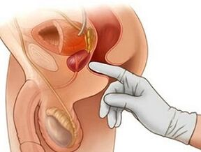 Prostatako masajea prostatitisaren tratamendurako gizonezkoetan
