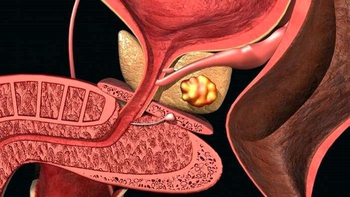 Harri-gordailuak prostatako prostatitis kalkuluarekin