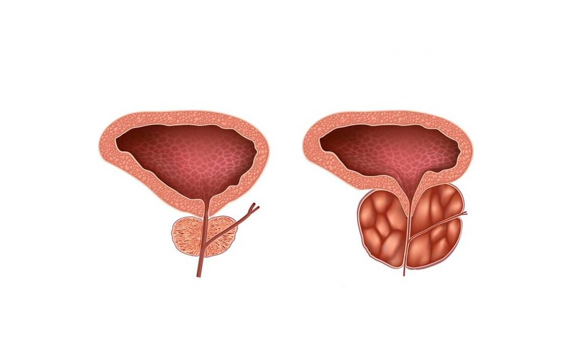 prostatitisaren sintomak gizonezkoetan