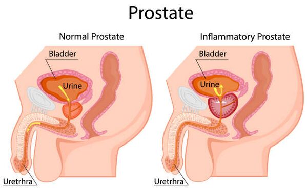 prostata osasuntsua eta hanturatua