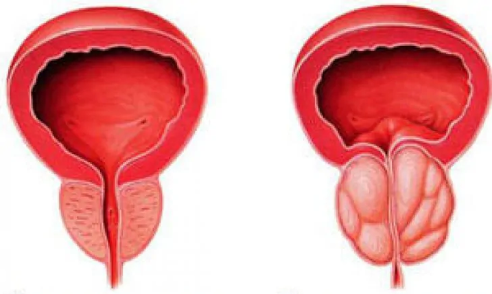 Prostata normala (ezkerrean) eta prostatitis kroniko hanturatua (eskuinean)