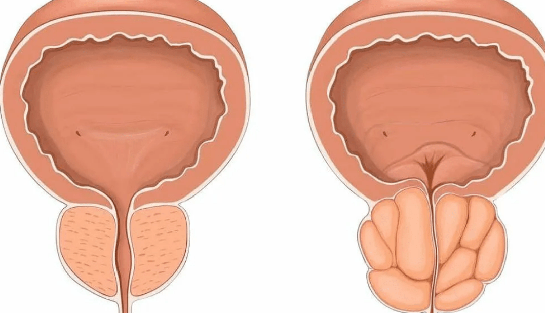 prostata osasuntsua eta gaixoa