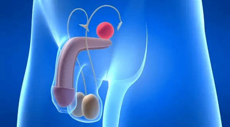 Prostatitisa gizonen prostatako guruinaren hantura da, tratamendu konplexua behar duena